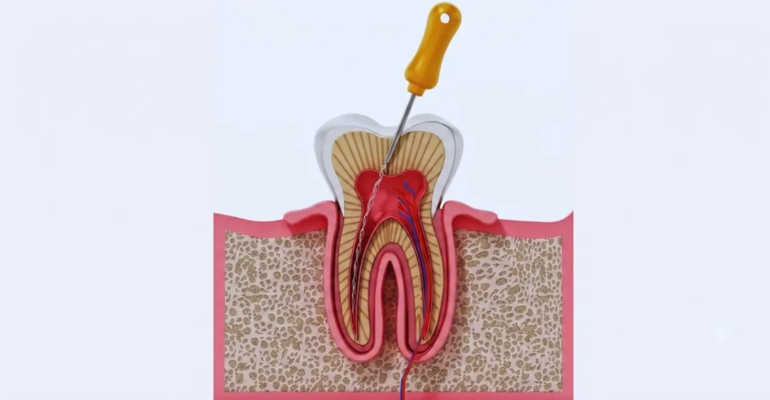 Holistic Alternative to Root Canal 2